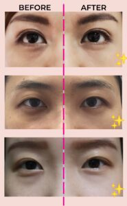 Eye bag removal in Singapore