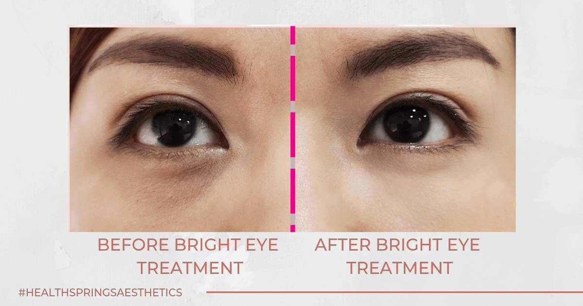 Eye Bag Removal Singapore Cost
