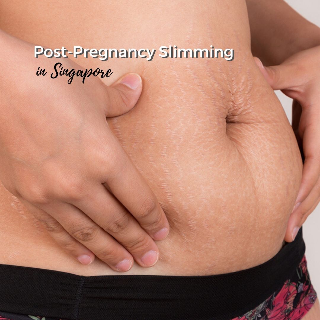 Post-Pregnancy Slimming Singapore