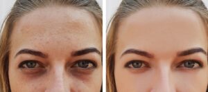 Best eye bag removal in Singapore