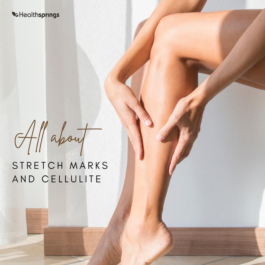 Everything you need to know about Stretch Marks and Cellulite